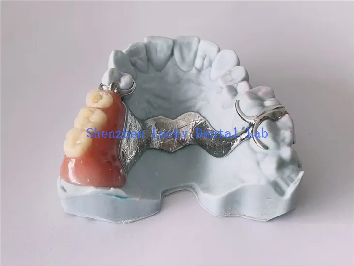 Framework z dentystycznym metalem z dentystycznym 3D z podwójnym zapięciem Aker