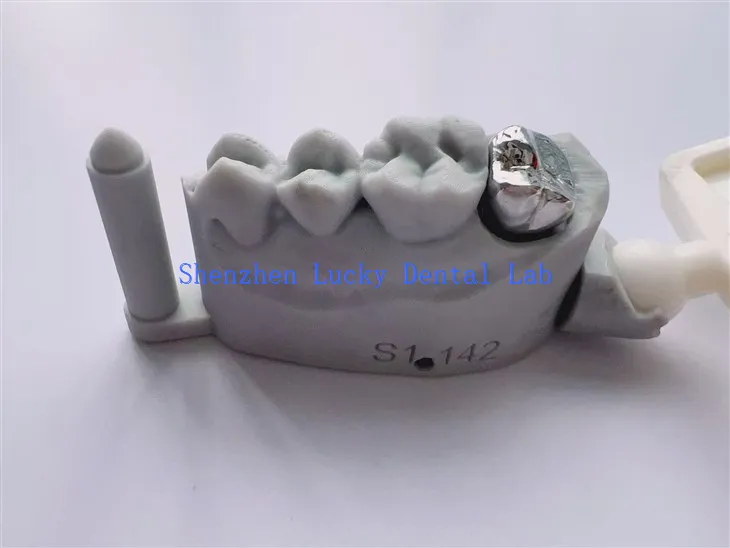 Full metalowa korona z dentystycznego wydruku 3D