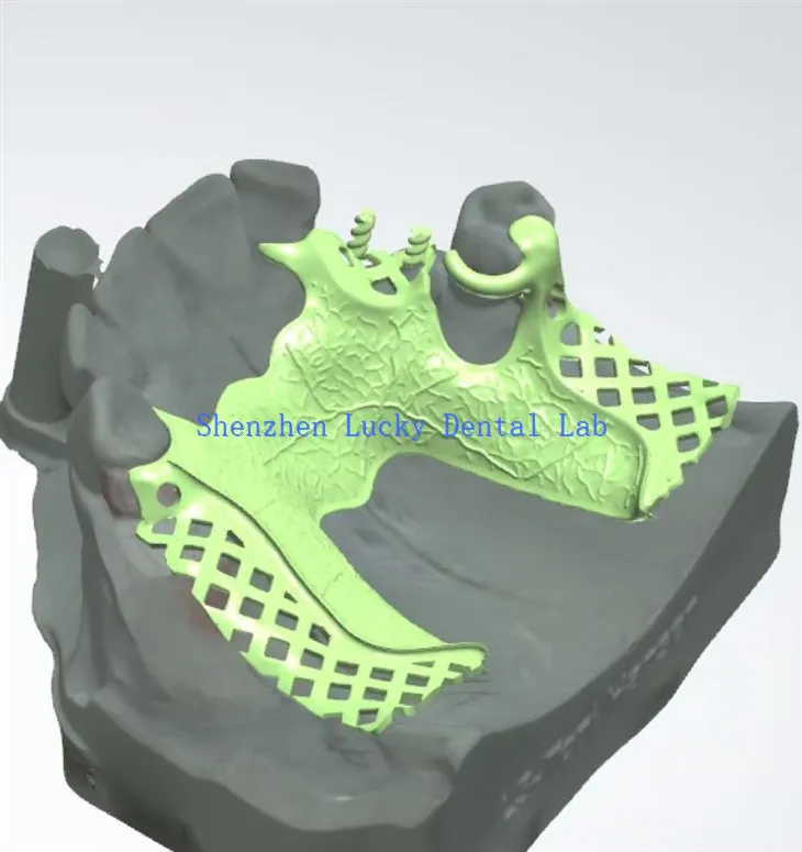 Producenci ramy dentystycznej z metalami dentystycznymi 3D