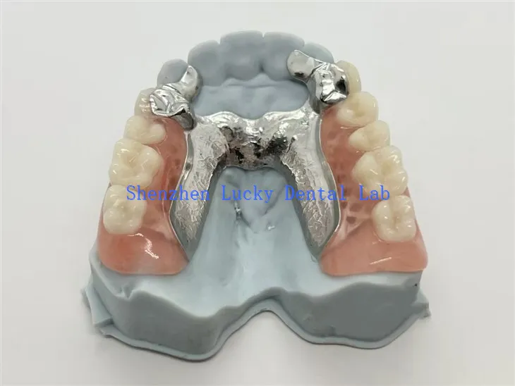 Wydrukowana w 3D metalowa proteza częściowa ze stopowym podkładem zęba
