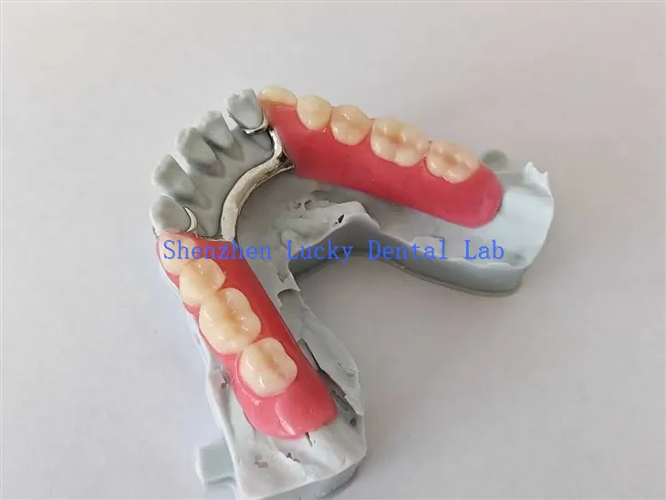 Drukuj 3D Częściowa proteza akrylowa z metalową strukturą próba w laboratorium dentystycznym