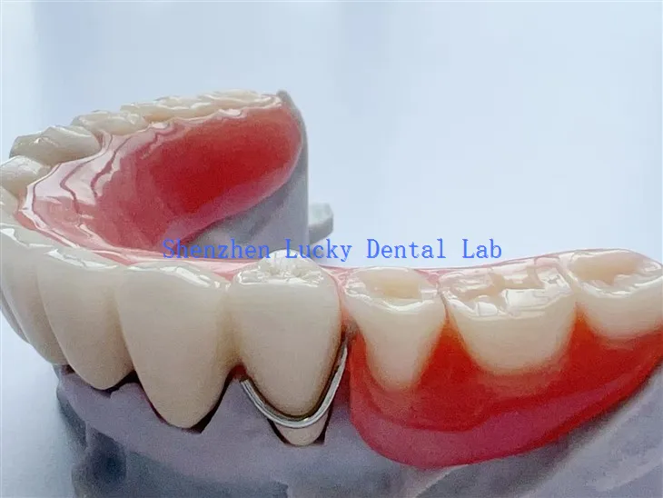 Bridge 3D PFM COCR z częściową protezą akrylową
