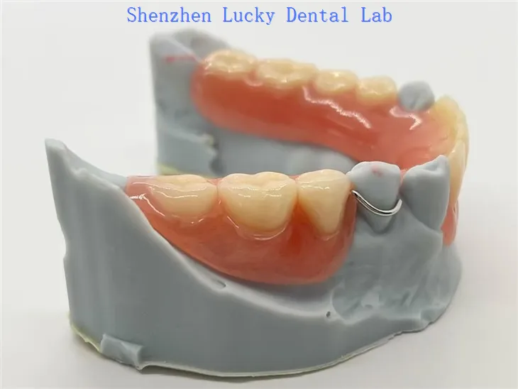 Acryl zdejmowana częściowa proteza z drutu