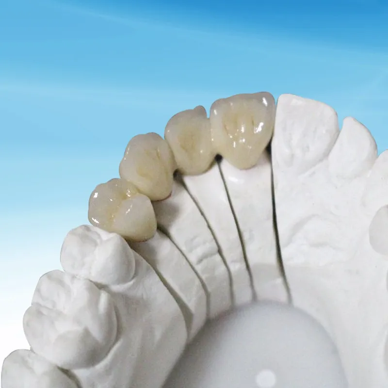 Estetyczny most dentystyczny całkowicie porcelanowy IPS Emax