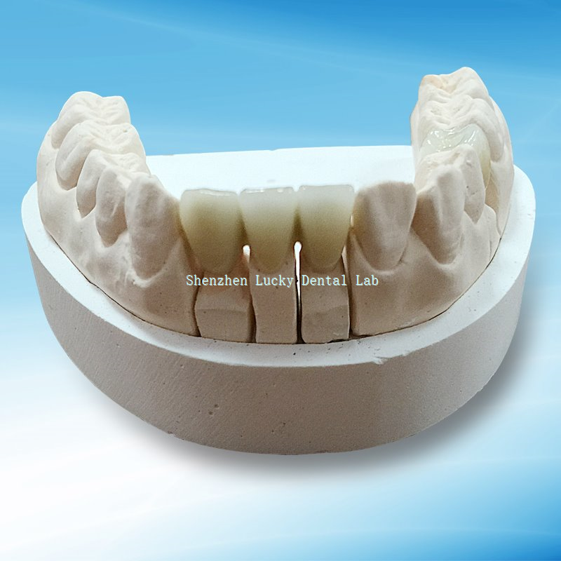 Estetyczny most koronowy PFM Co Cr