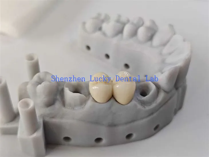 Estetyczny most dentystyczny PFM COCR