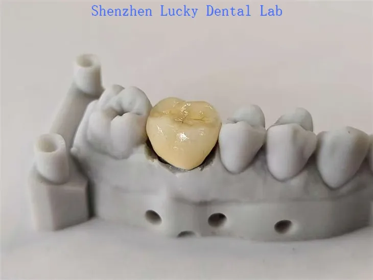 Estetyczna fabryka korony PFM COCR COCR