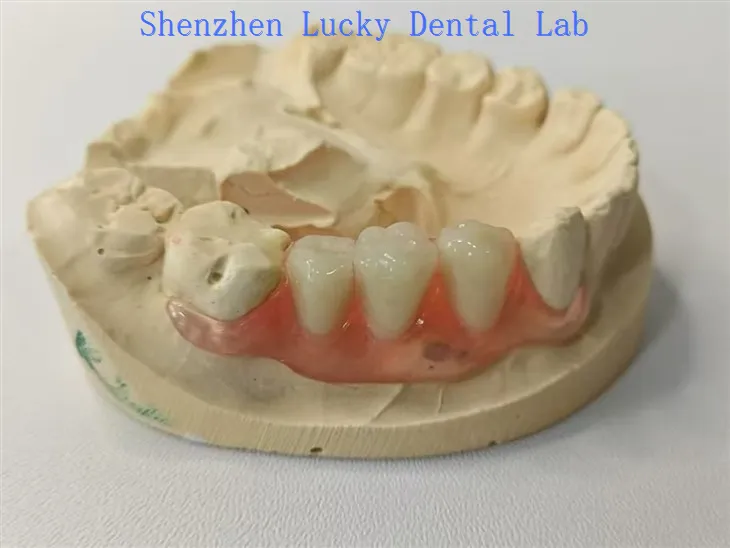 Estetyczny Flipper Valplast Valplast