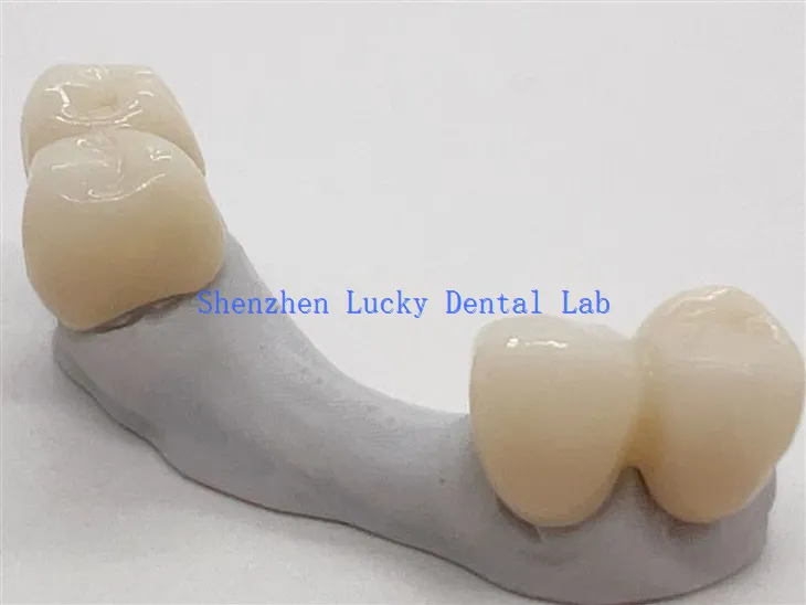 Estetyczny most dentystyczny z tlenku cyrkonu