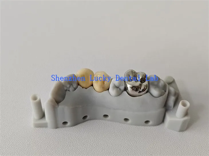 Estetyczny druk 3D FMC i PFM COCR Crown wyprodukowane w Chinach