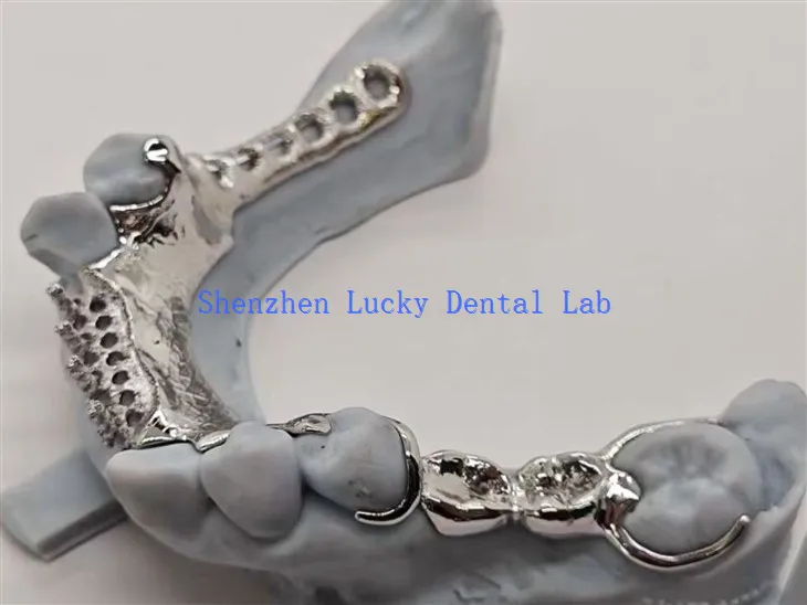 Konstrukcja zęba wzmocniona stopem z metalową ramą