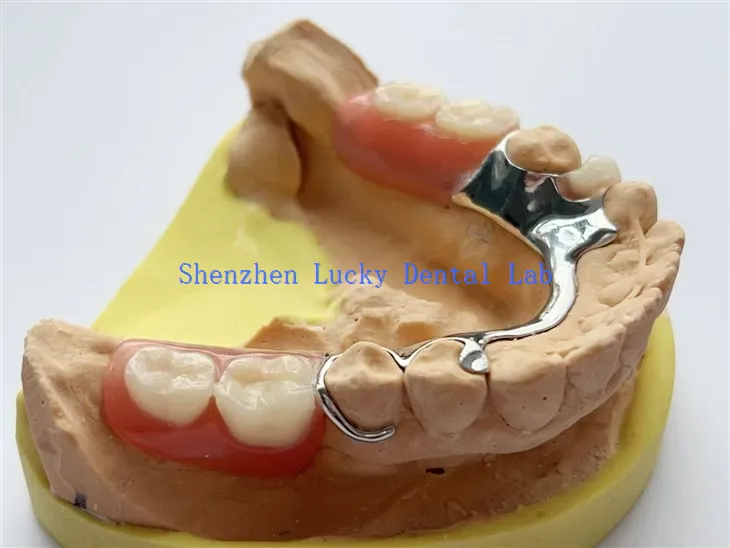 Ramie metalowych zębatego z prętem językowym z częściową protezą akrylową