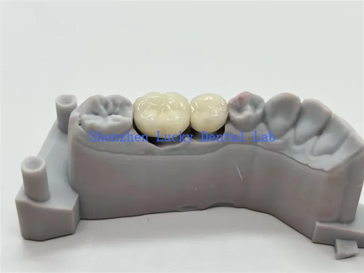 Korony dentystyczne ze stopu CoCr PFM