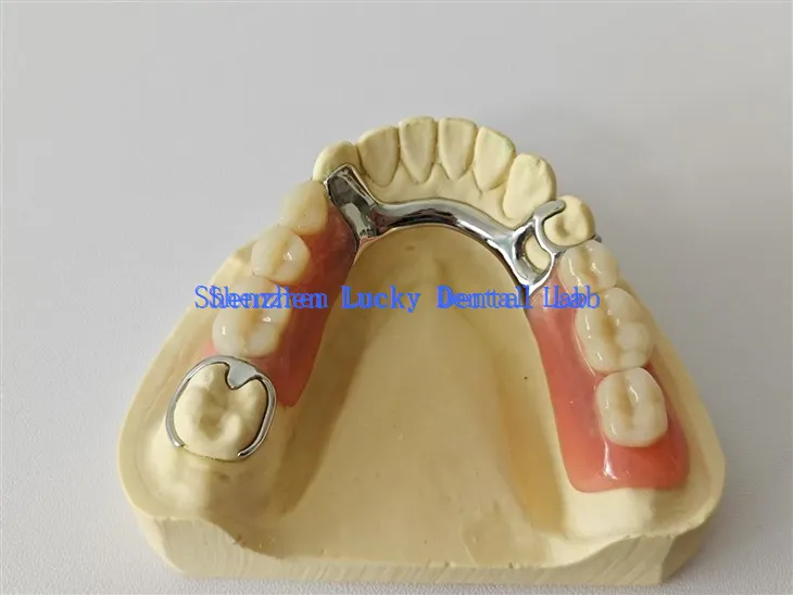 Wygodna proteza akrylowa z metalowym szkieletem dentystycznym