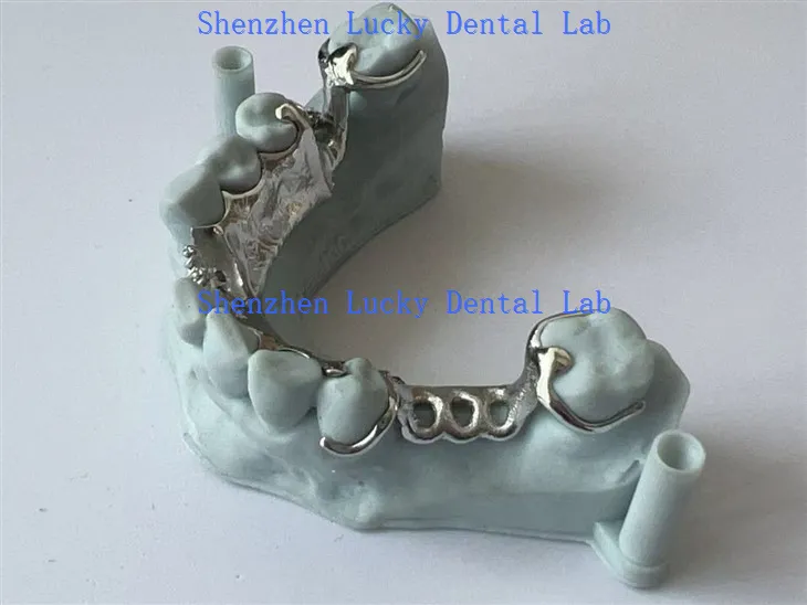 Metalowy metalowy szkielet z laboratorium dentystycznym płyty językowej