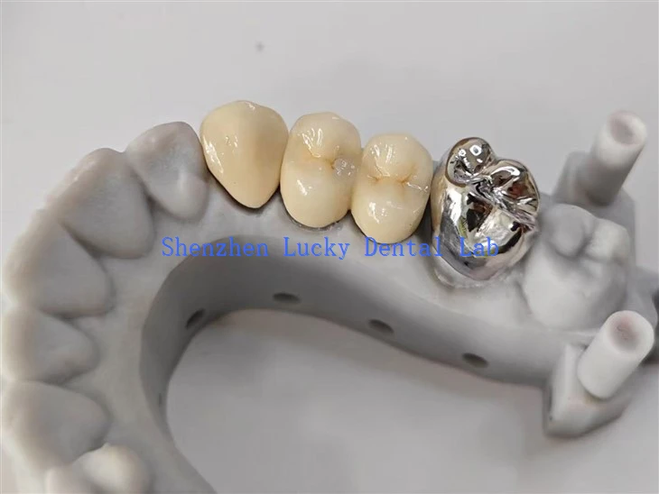 Wysokiej jakości most dentystyczny PFM COCR z pełną metalową koroną zębną