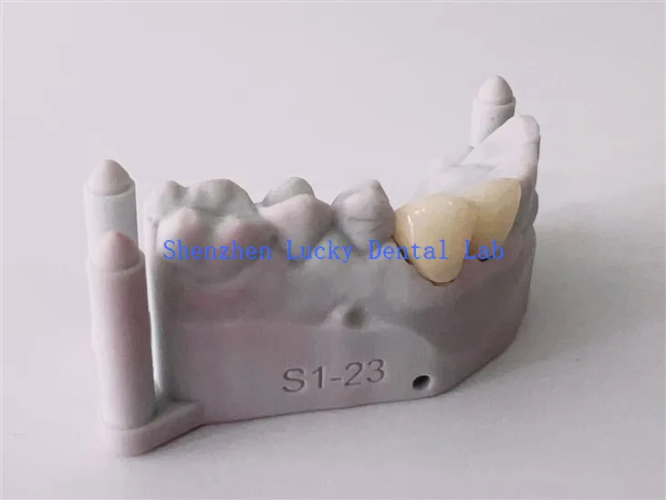 Naturalny producenci mostów dentystycznych 3D PFM COCR