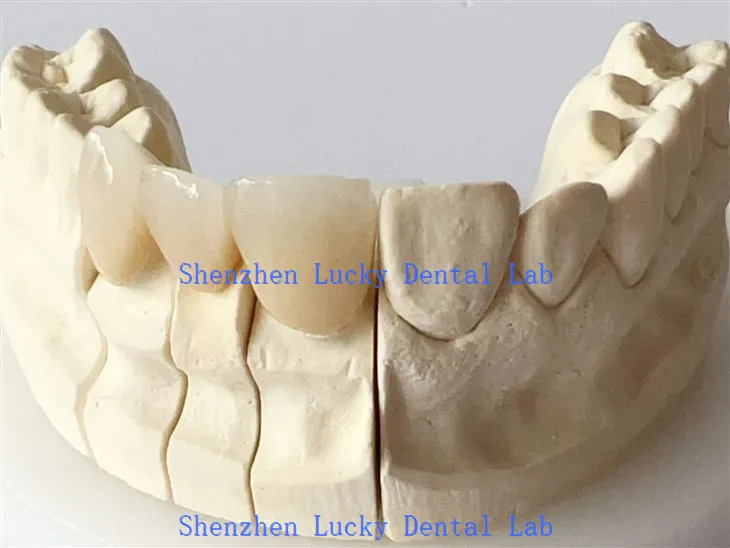 Dental Full Contour Crown Crown Lab