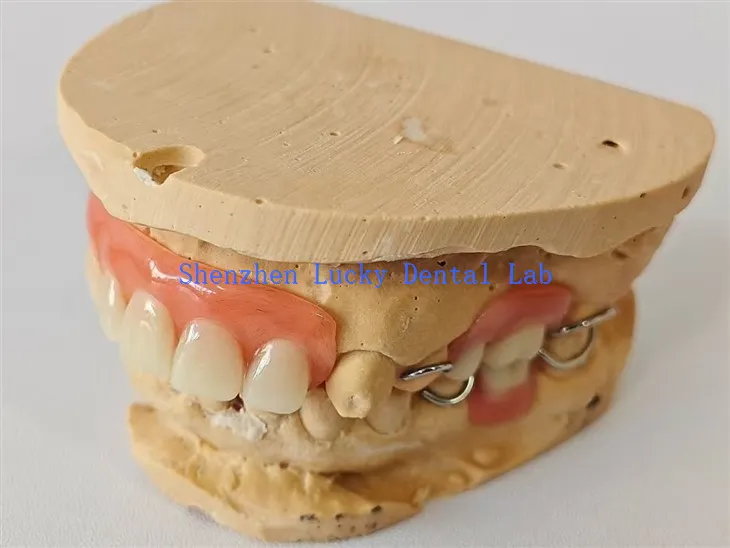 Częściowa proteza akrylowa z metalowym zapięciem