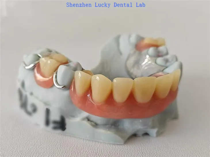 Częściowa proteza akrylowa z metalową ramą z zapięciem z drutu