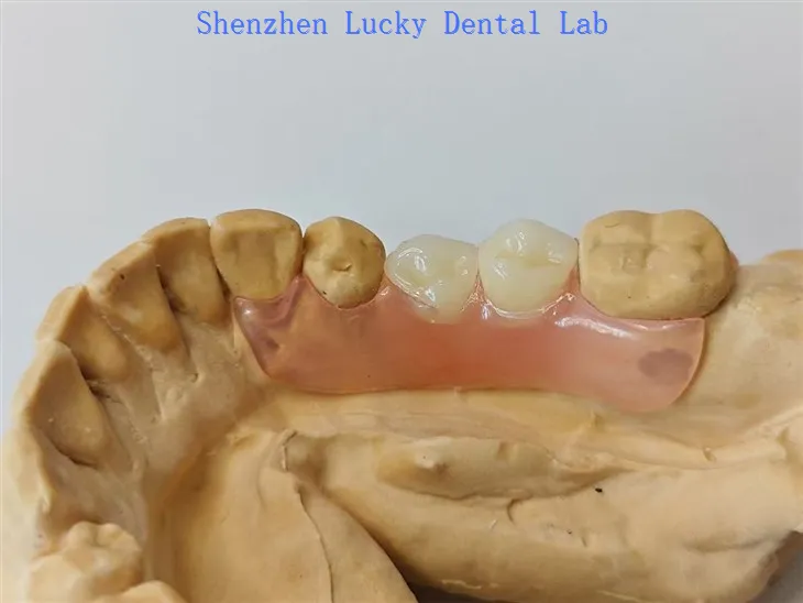 Częściowa elastyczna proteza dentystyczna z producentami zapięcia Valplast