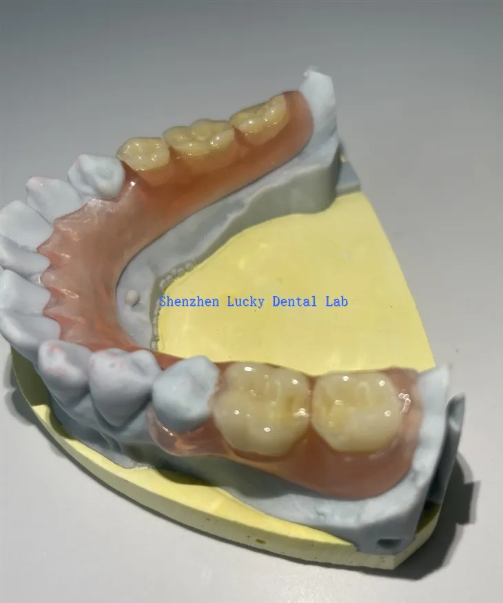 Częściowa elastyczna proteza