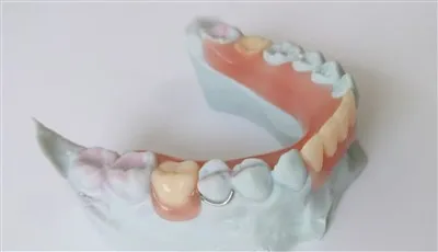 Częściowy akrylowy protezy z drutu z drutu z drutu