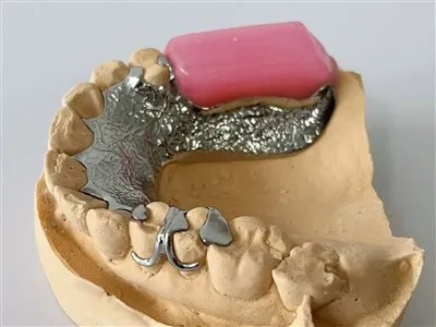 Metalowa rama z obręczą woskową i laboratorium dentystycznym płyty językowej